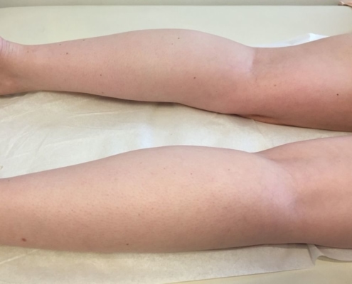Full legs after 6 treatments after 2 months