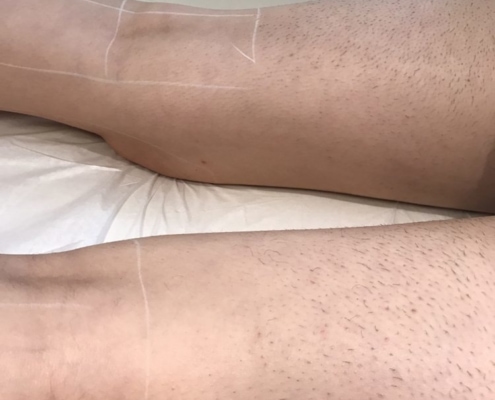 Lower legs after multiple treatments in contrast to untreated upper legs