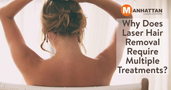 Why Does Laser Hair Removal Require Multiple Treatments?