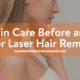 Skin Care Before and After Laser Hair Removal