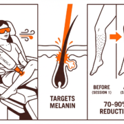 The Ultimate Guide to Lower Legs Laser Hair Removal in Manhattan 6 Image March 16 2026 11 07 AM